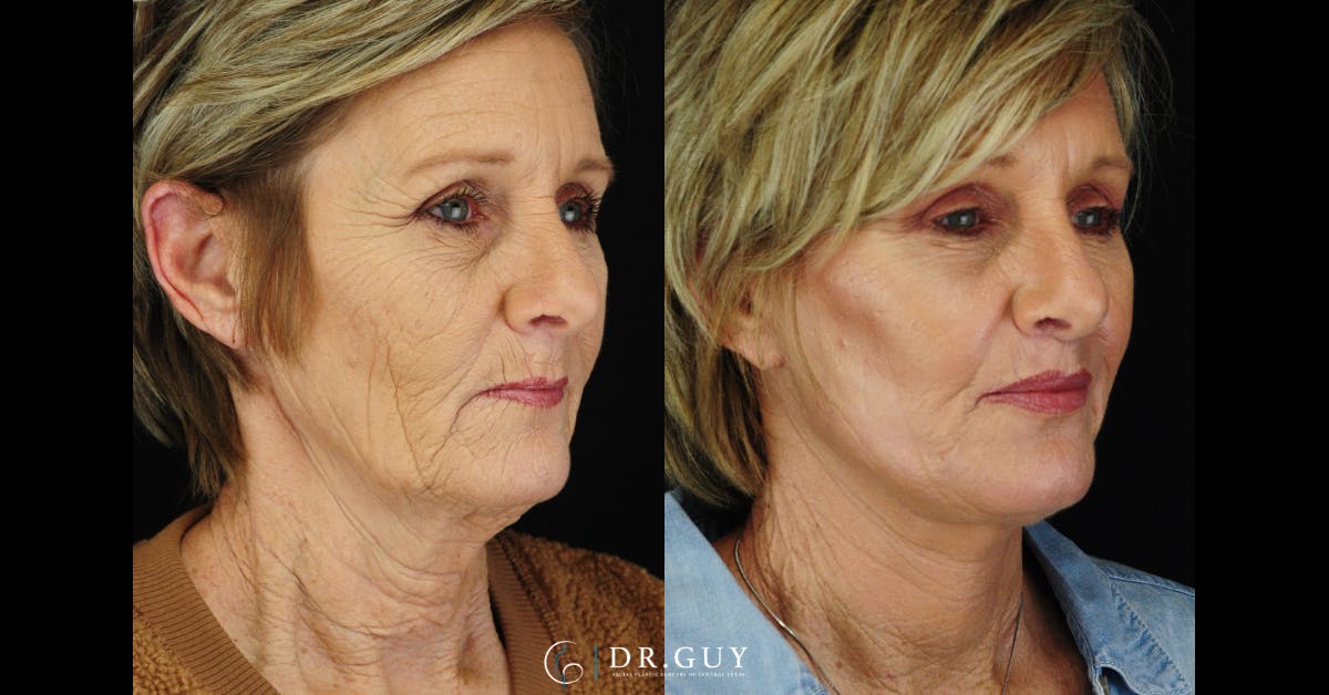 Lip Lift Before & After Gallery - Patient 210418 - Image 4