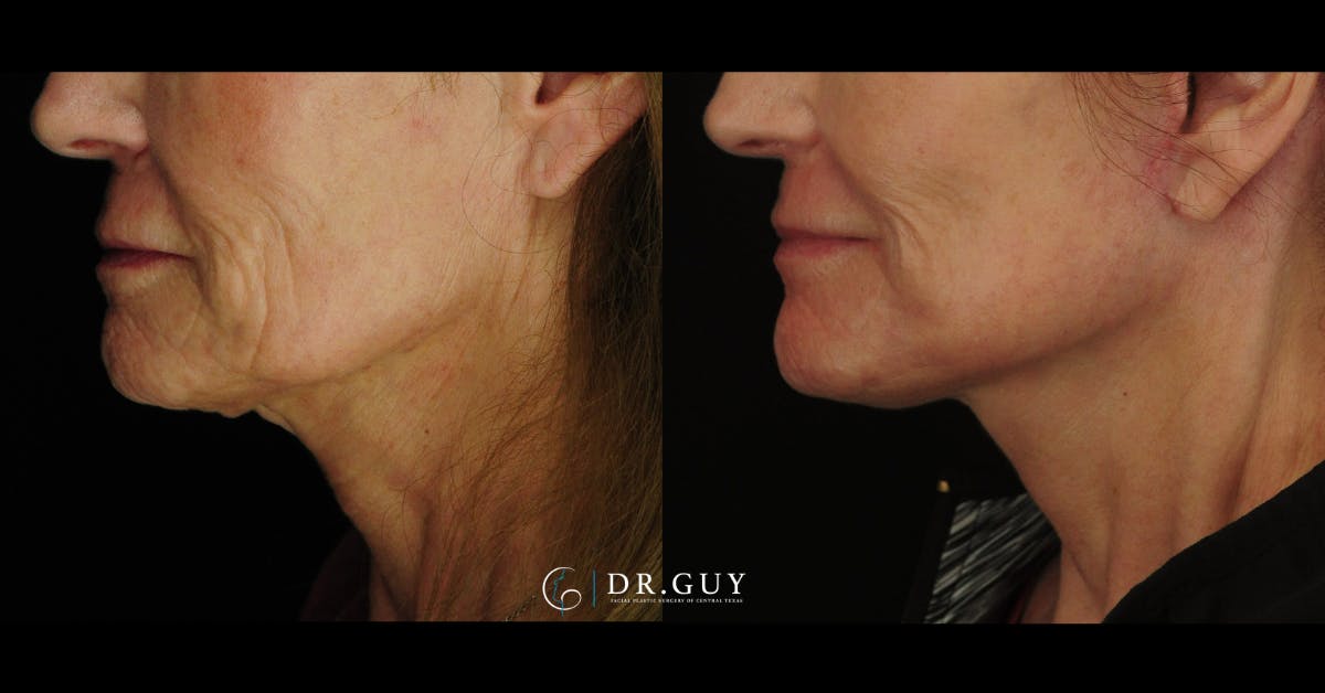 Mini Facelift Before & After Gallery - Patient 222972 - Image 2
