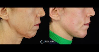 Chin Before & After Gallery - Patient 343009 - Image 1