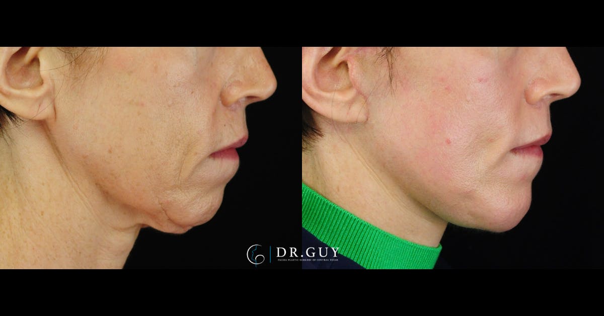 Chin Before & After Gallery - Patient 343009 - Image 1