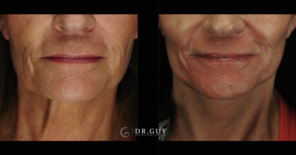 Mini Facelift Before & After Gallery - Patient 222972 - Image 3