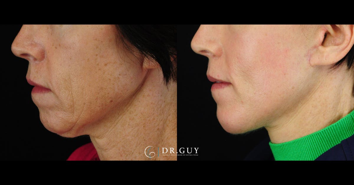 Chin Before & After Gallery - Patient 343009 - Image 2
