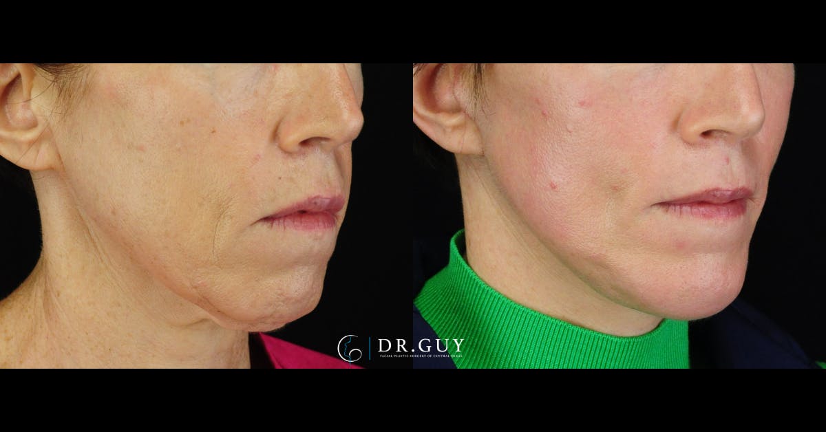 Chin Before & After Gallery - Patient 343009 - Image 3