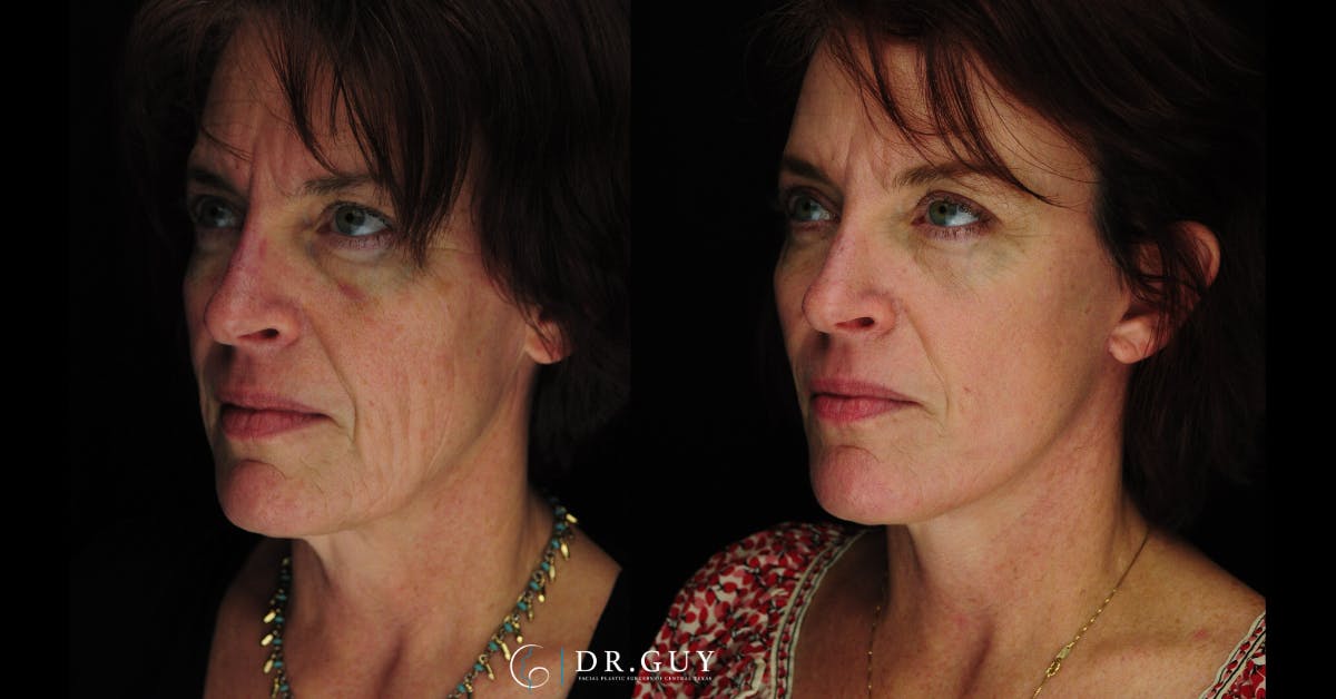 Mini Facelift Before & After Gallery - Patient 389522 - Image 1
