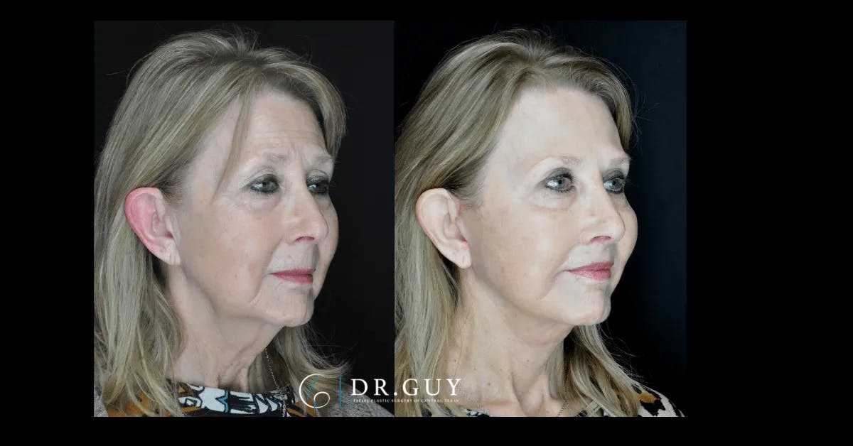 Lip Lift Before & After Gallery - Patient 122229 - Image 3