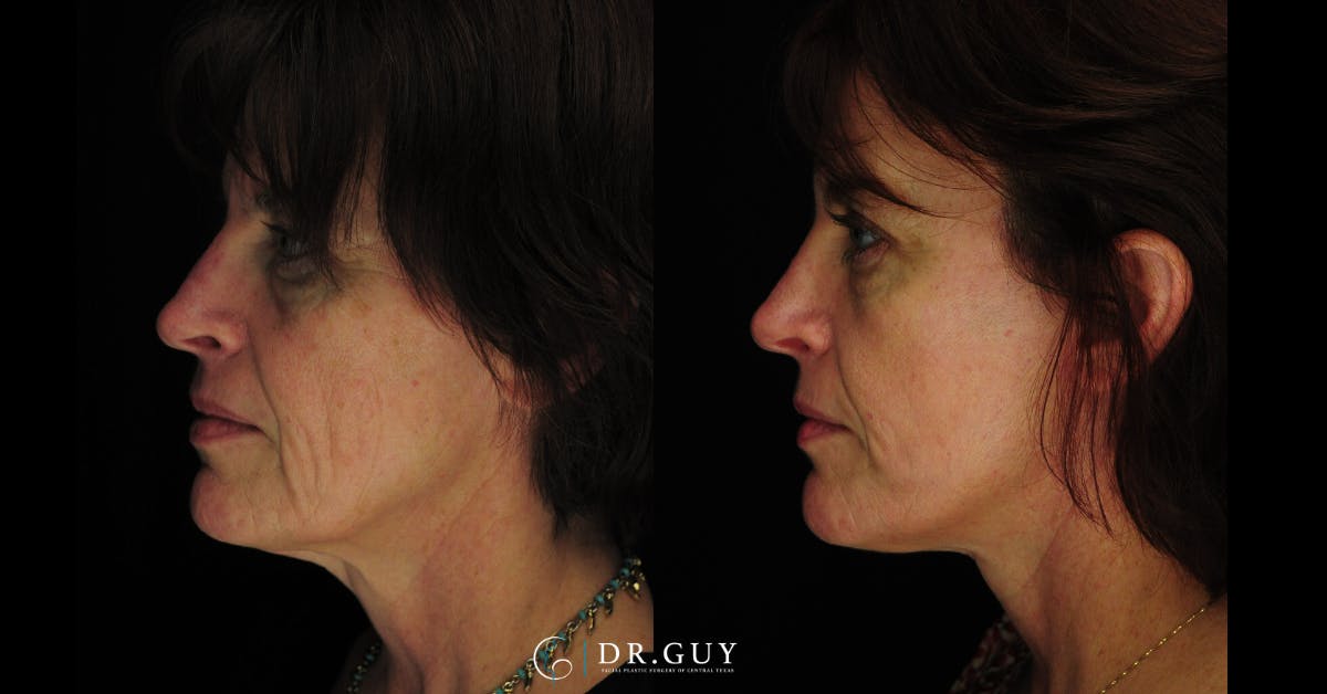 Mini Facelift Before & After Gallery - Patient 389522 - Image 2