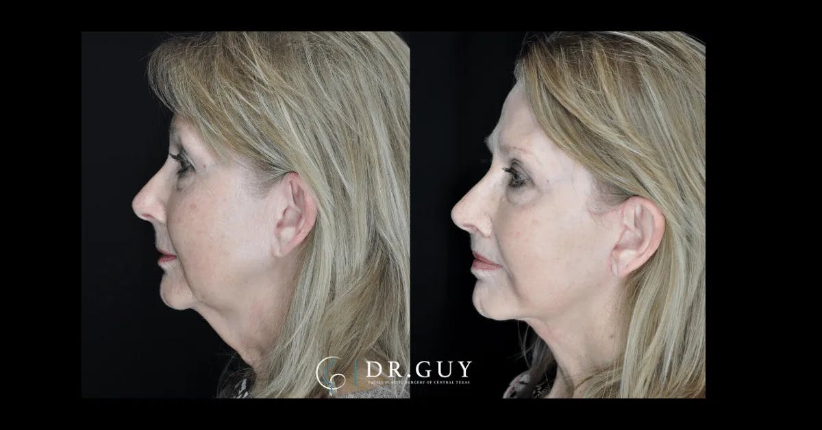 Lip Lift Before & After Gallery - Patient 122229 - Image 4