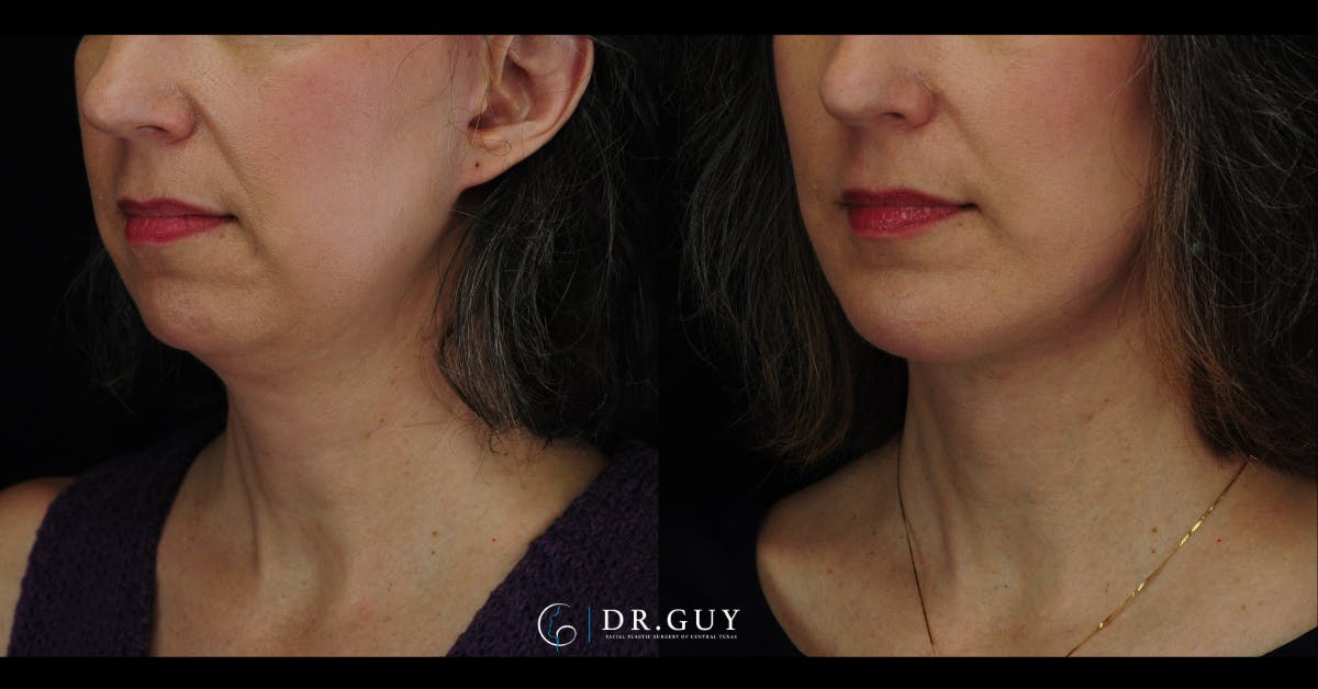 Chin Before & After Gallery - Patient 385106 - Image 2