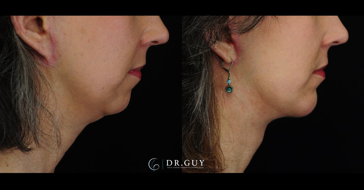 Chin Before & After Gallery - Patient 385106 - Image 3