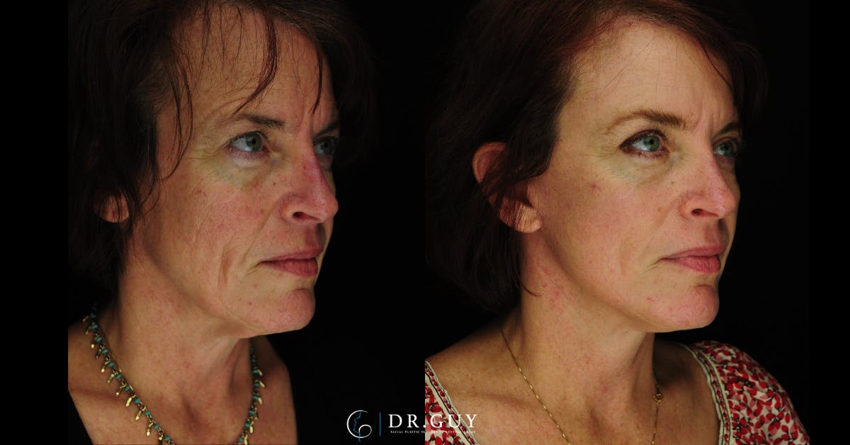 Mini Facelift Before & After Gallery - Patient 389522 - Image 4