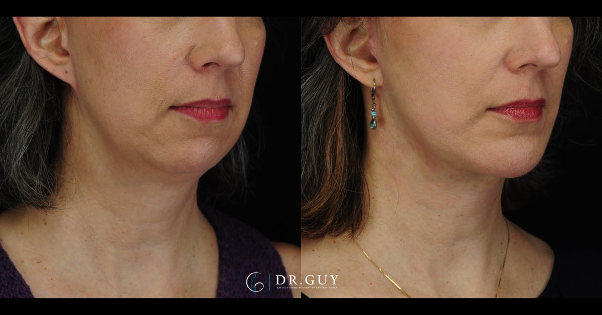 Chin Before & After Gallery - Patient 385106 - Image 4