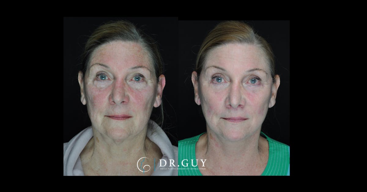 Lip Lift Before & After Gallery - Patient 291752 - Image 3