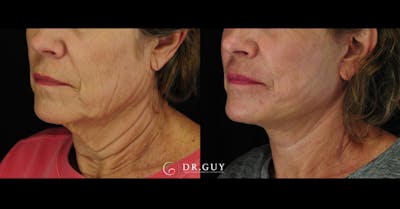 Mini Facelift Before & After Gallery - Patient 190658 - Image 1