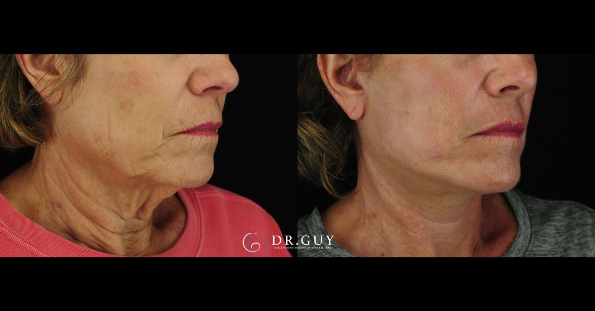 Mini Facelift Before & After Gallery - Patient 190658 - Image 2