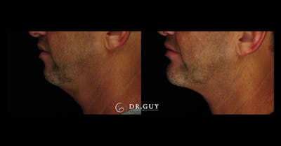 Chin Before & After Gallery - Patient 232178 - Image 1