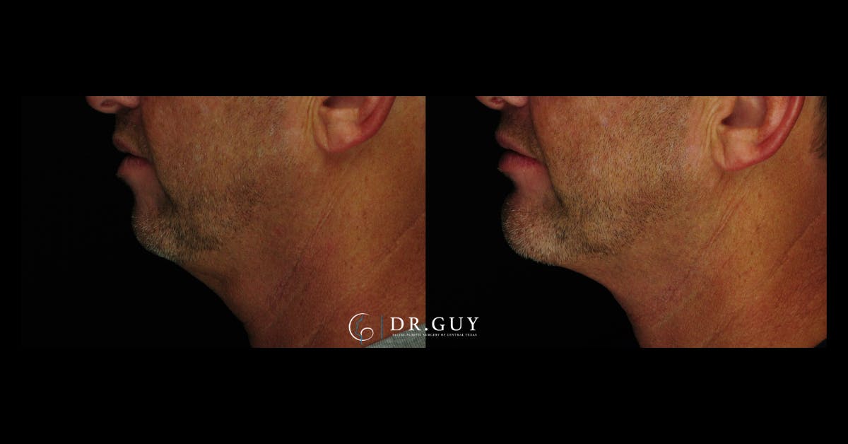 Chin Before & After Gallery - Patient 232178 - Image 1