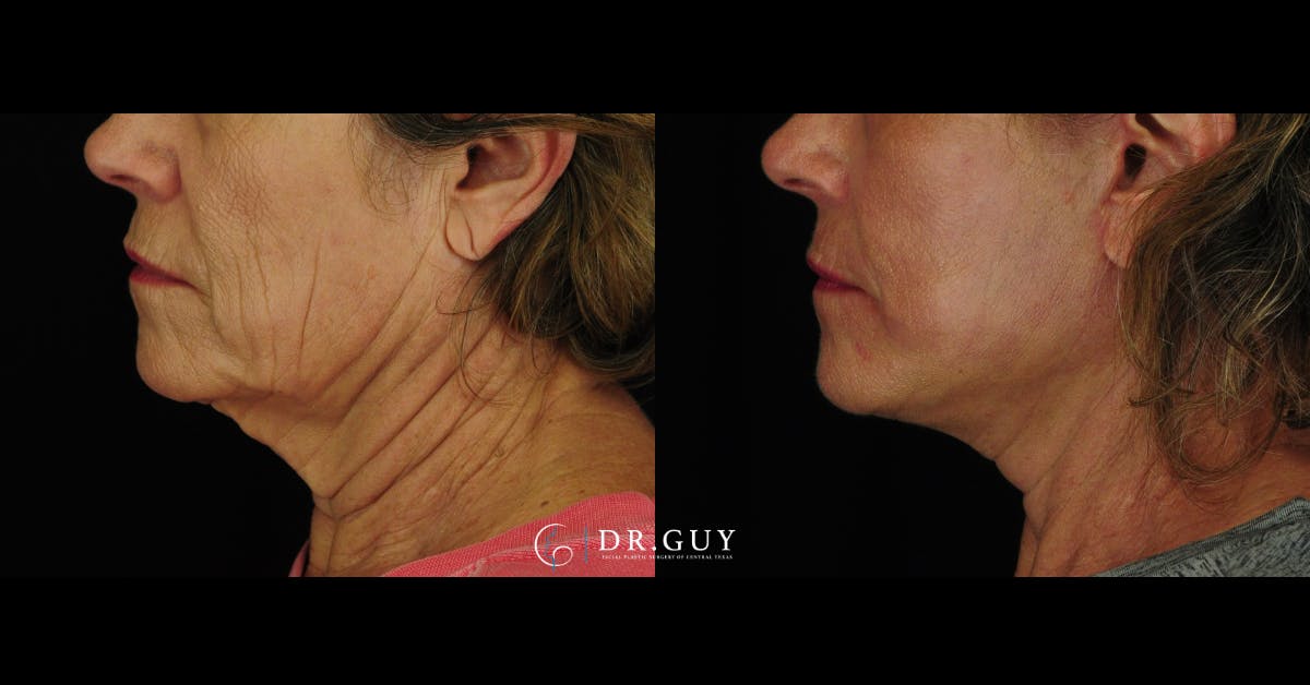 Mini Facelift Before & After Gallery - Patient 190658 - Image 3