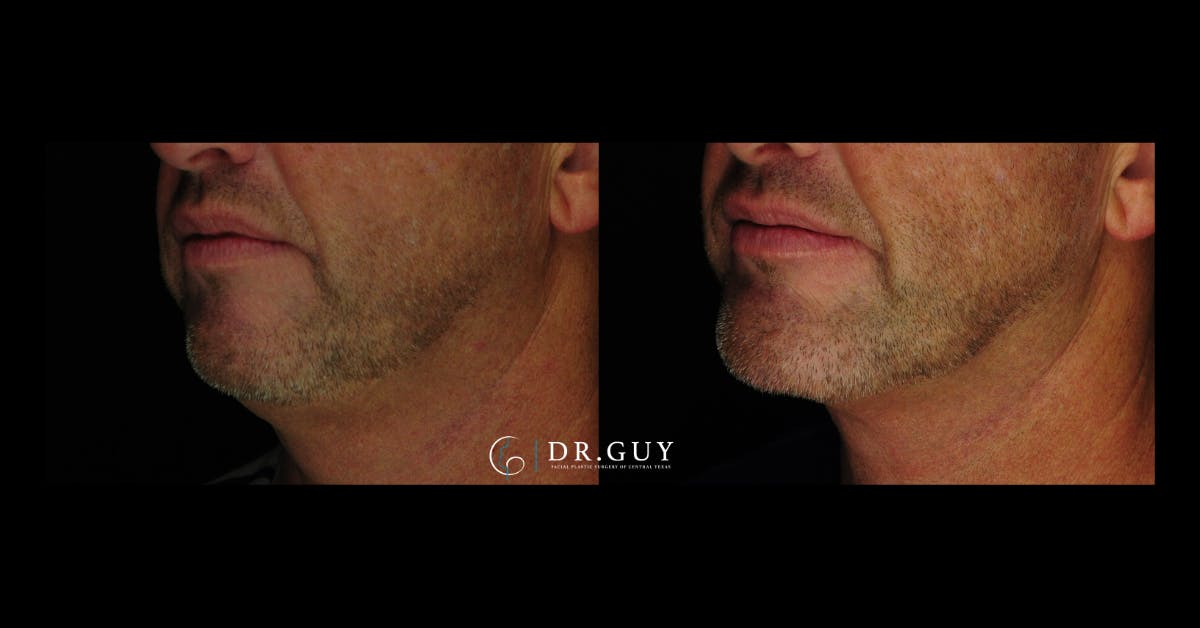 Chin Before & After Gallery - Patient 232178 - Image 2