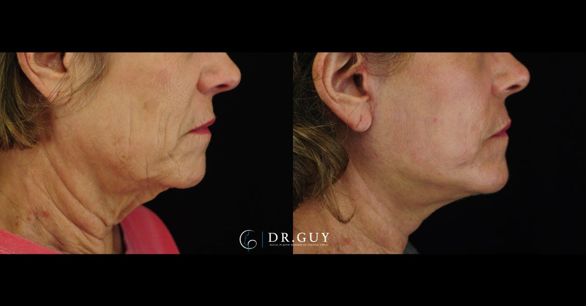Mini Facelift Before & After Gallery - Patient 190658 - Image 4