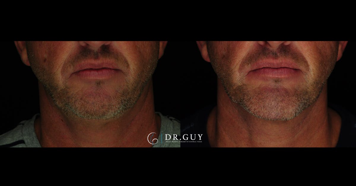 Chin Before & After Gallery - Patient 232178 - Image 3