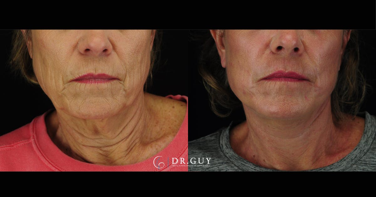 Mini Facelift Before & After Gallery - Patient 190658 - Image 5