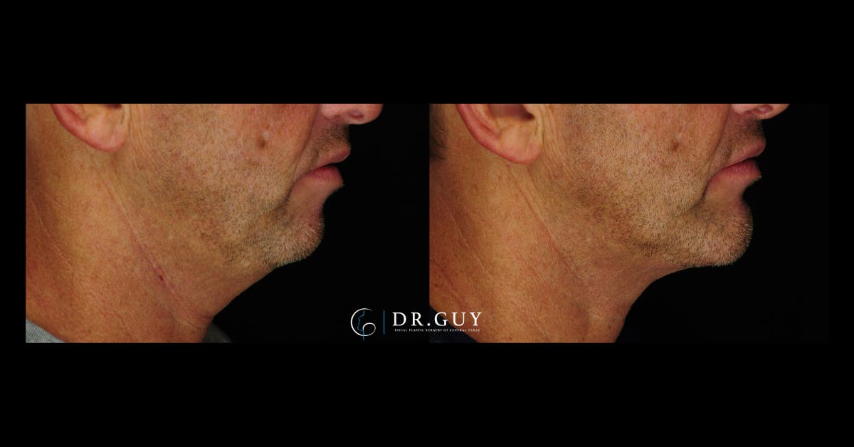 Chin Before & After Gallery - Patient 232178 - Image 4