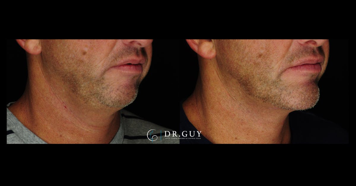Chin Before & After Gallery - Patient 232178 - Image 5