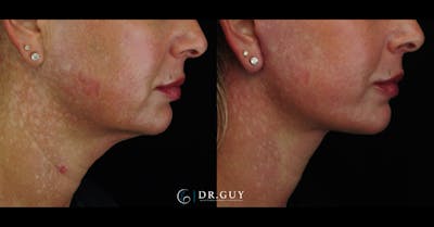 Mini Facelift Before & After Gallery - Patient 203924 - Image 1