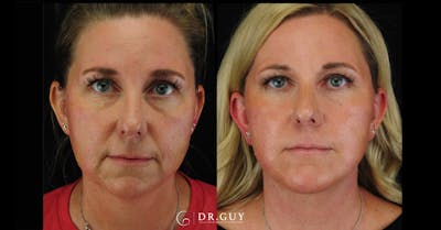 Chin Before & After Gallery - Patient 326465 - Image 1