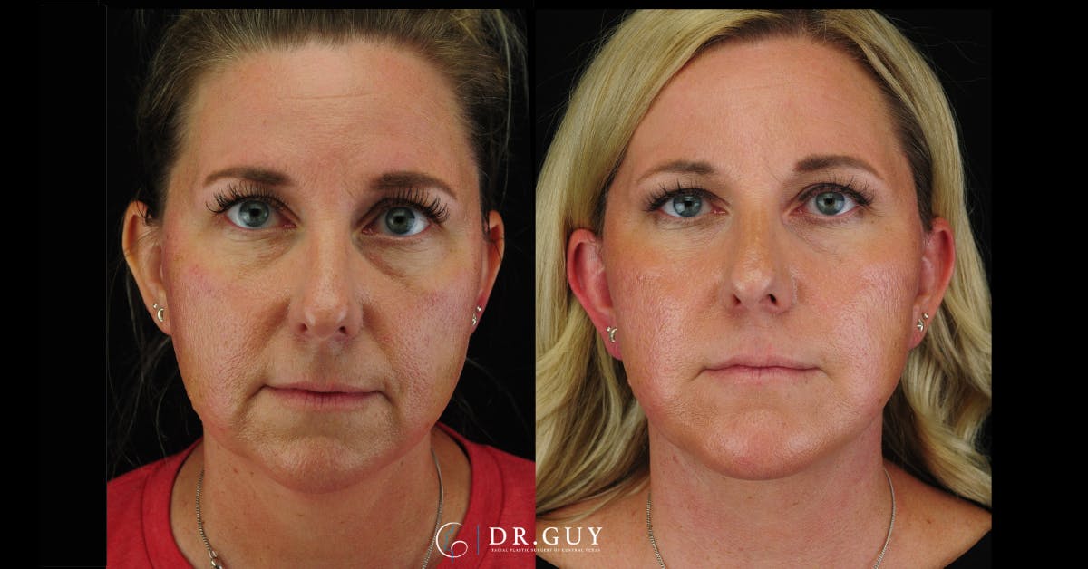 Chin Before & After Gallery - Patient 326465 - Image 1