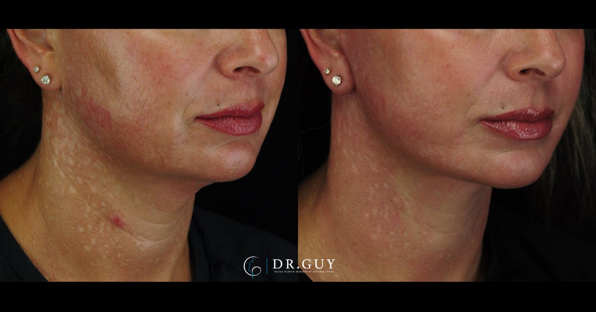 Mini Facelift Before & After Gallery - Patient 203924 - Image 2