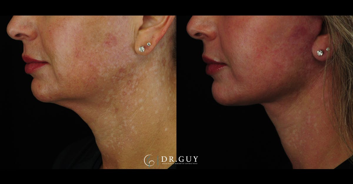 Mini Facelift Before & After Gallery - Patient 203924 - Image 3
