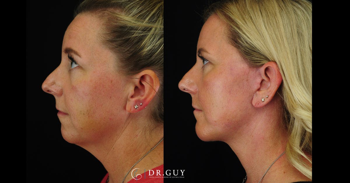 Chin Before & After Gallery - Patient 326465 - Image 2
