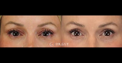 Upper Blepharoplasty Before & After Gallery - Patient 650767 - Image 1