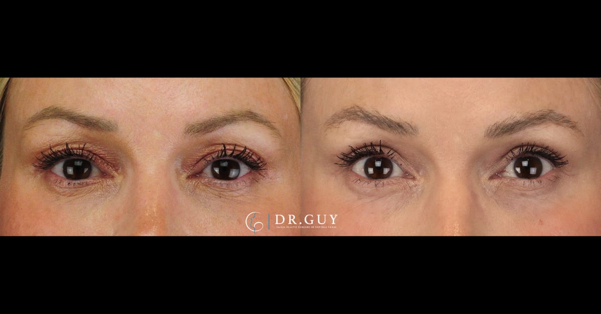 Upper Blepharoplasty Before & After Gallery - Patient 650767 - Image 1