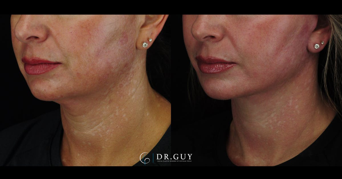 Mini Facelift Before & After Gallery - Patient 203924 - Image 4