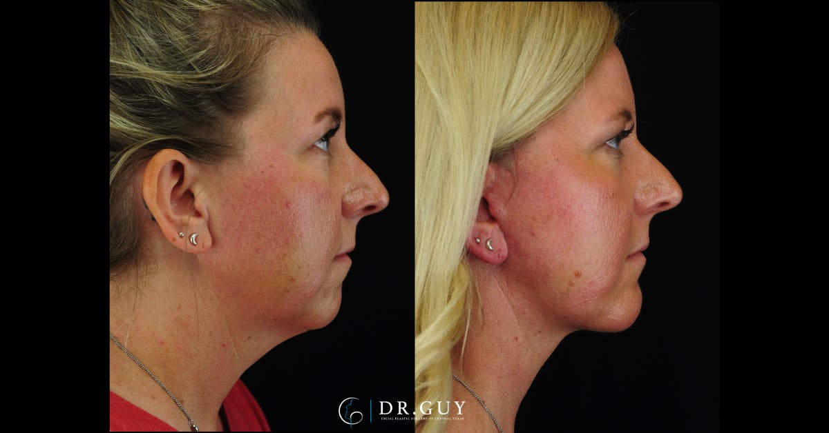 Chin Before & After Gallery - Patient 326465 - Image 3