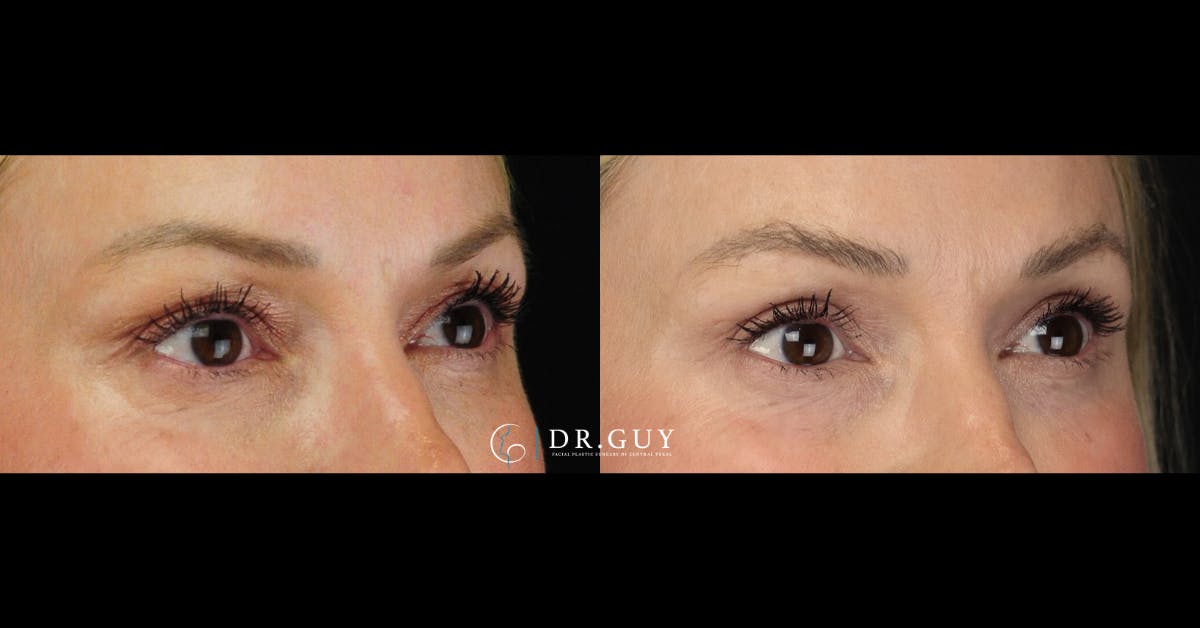 Upper Blepharoplasty Before & After Gallery - Patient 650767 - Image 2