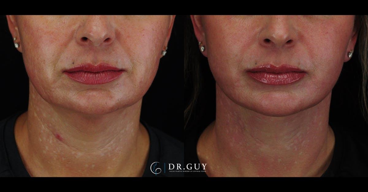 Mini Facelift Before & After Gallery - Patient 203924 - Image 5