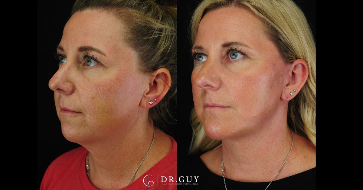 Chin Before & After Gallery - Patient 326465 - Image 4