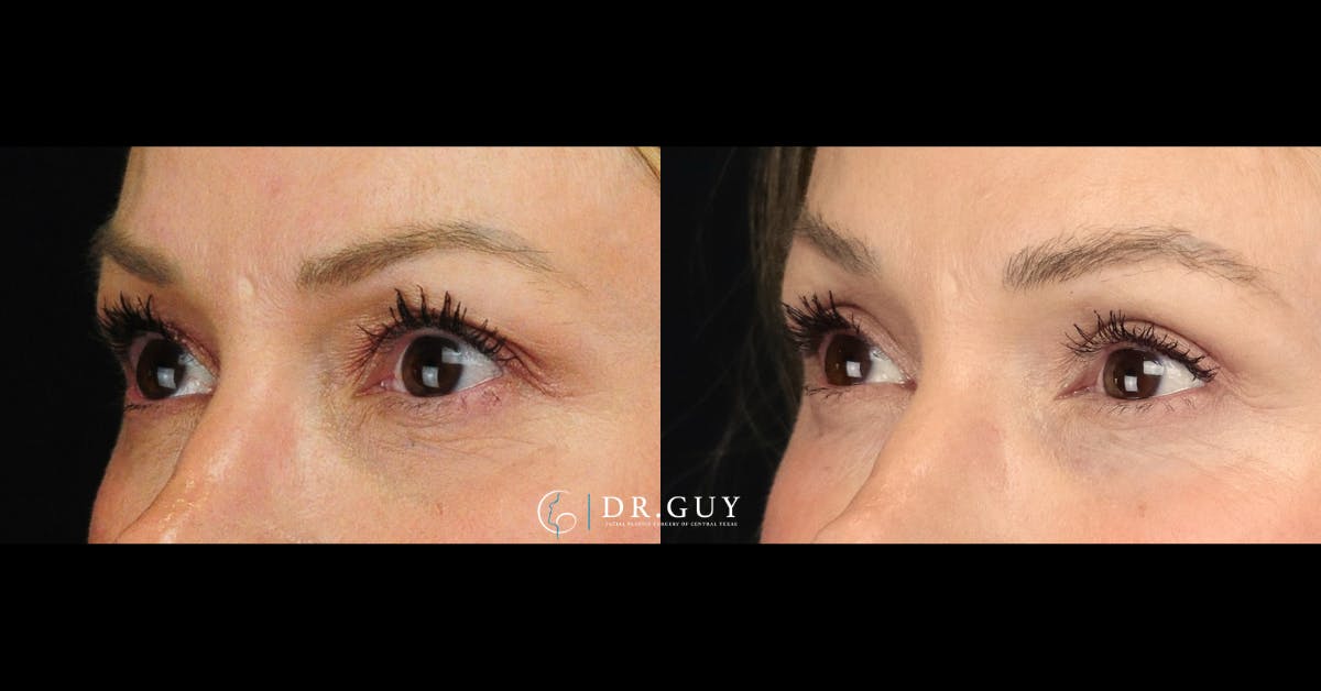 Upper Blepharoplasty Before & After Gallery - Patient 650767 - Image 3