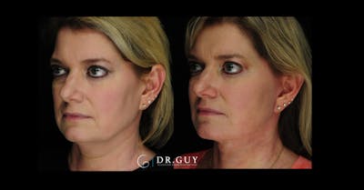 Mini Facelift Before & After Gallery - Patient 246058 - Image 1