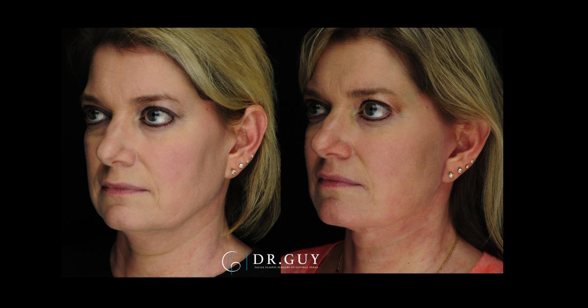 Mini Facelift Before & After Gallery - Patient 246058 - Image 1