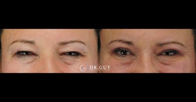 Upper Blepharoplasty Before & After Gallery - Patient 306213 - Image 1