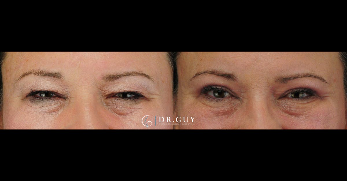 Upper Blepharoplasty Before & After Gallery - Patient 306213 - Image 1