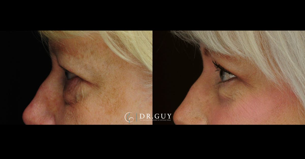Lower Blepharoplasty Before & After Gallery - Patient 384679 - Image 2