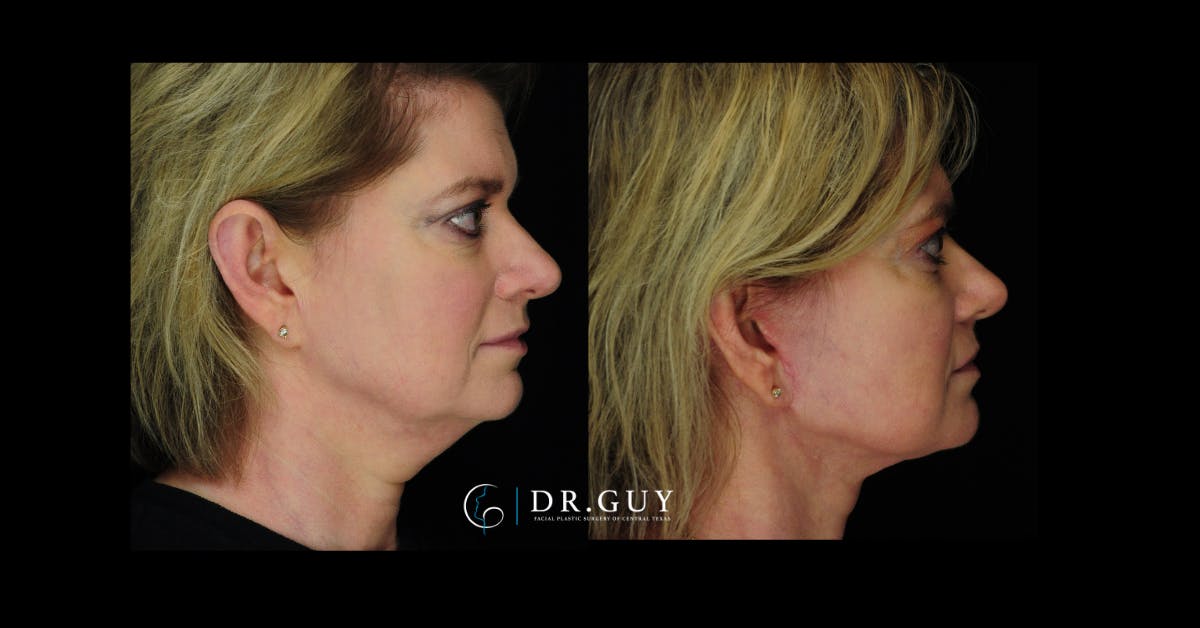 Mini Facelift Before & After Gallery - Patient 246058 - Image 2