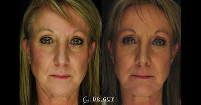 Chin Before & After Gallery - Patient 314905 - Image 1
