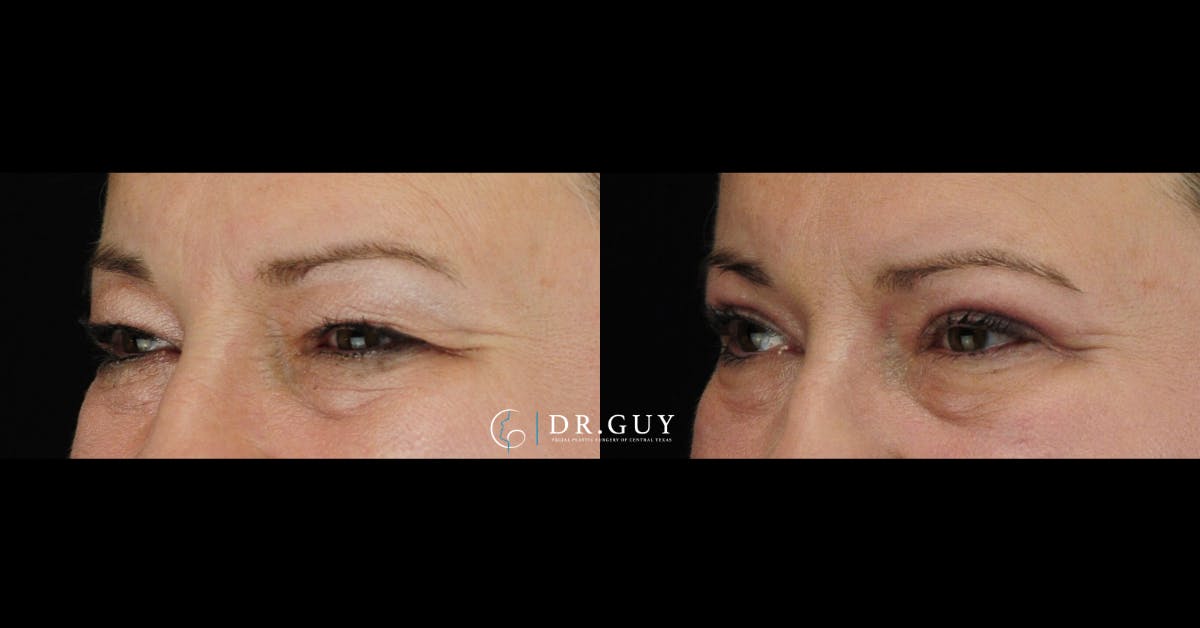 Upper Blepharoplasty Before & After Gallery - Patient 306213 - Image 2