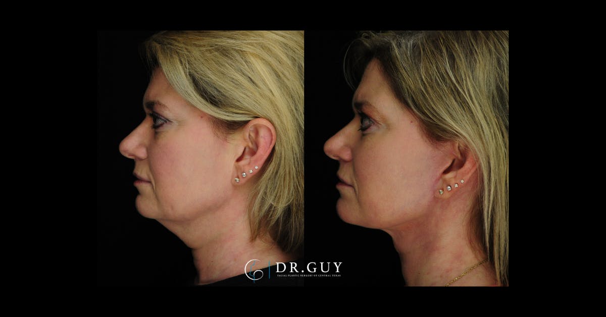 Mini Facelift Before & After Gallery - Patient 246058 - Image 3